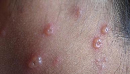 带状疱疹后遗神经痛的主要表现分析