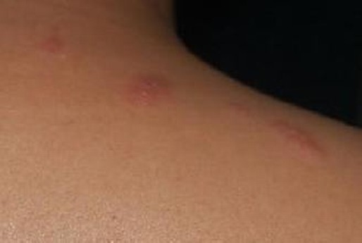 眼部带状疱疹的发生特点分析