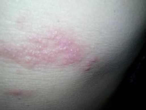 水痘是带状疱疹病毒感染引起