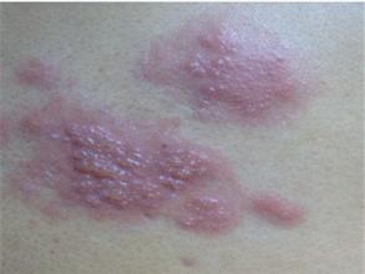 水痘和带状疱疹是不是一种病