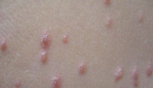 单纯痒疹的发病症状是什么