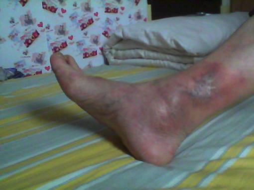 丹毒的中医治疗方法