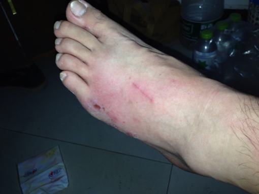 丹毒治疗以后的护理