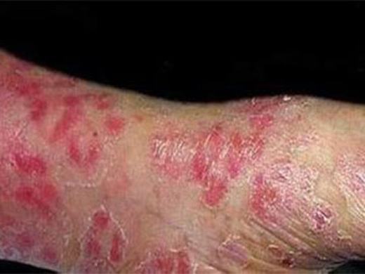 面部丹毒病人要避免皮肤损害