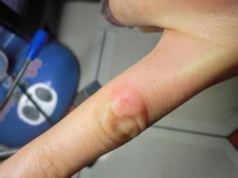 冻疮到底是怎们来的呢