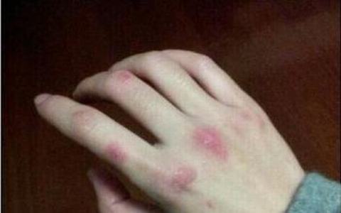 冻疮的症状到底都有什么呢