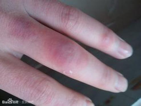 对付冻疮妈妈应该为孩子做哪些