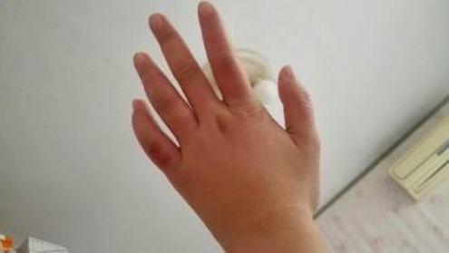 冬季经常穿靴子容易长冻疮