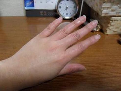 年轻女性如何对付冻疮发生