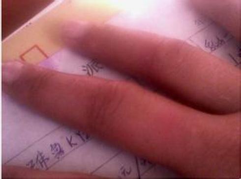 冻疮初期是怎样的