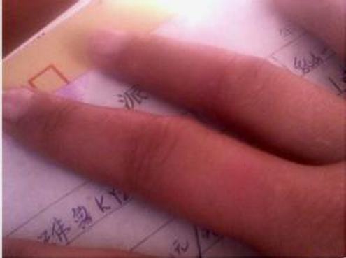 出现冻疮应该如何处理