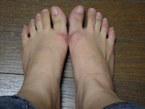 宝宝冻疮的护理