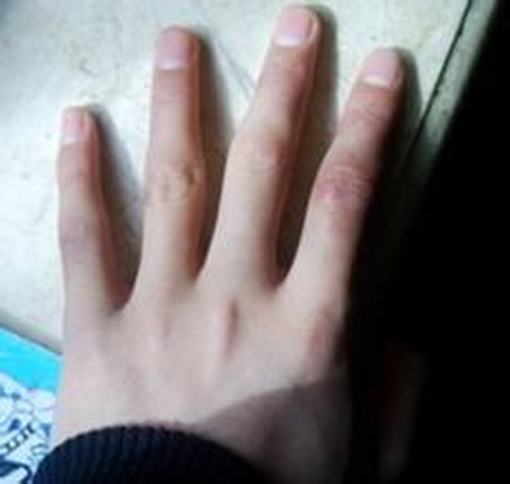 冻疮护理注意事项有哪些呢-