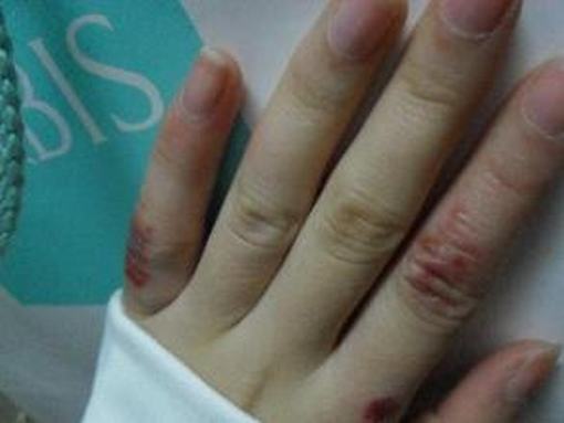专家教你如何鉴别冻疮