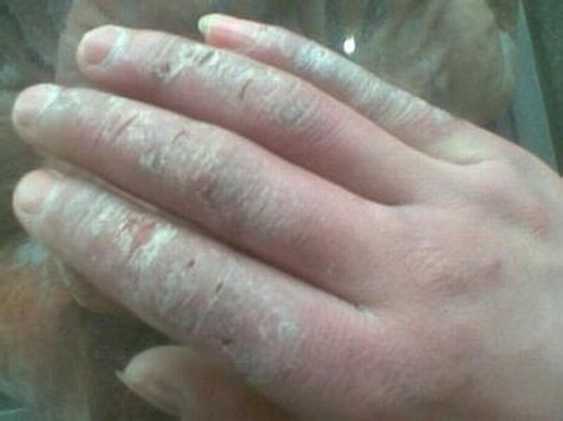 发生冻疮不要立即用热水泡
