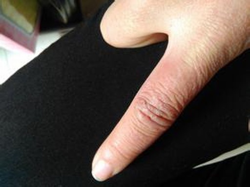 冻疮的护理要点都有什么呢呢