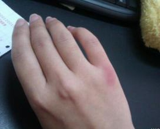 治疗冻疮的几种小偏方