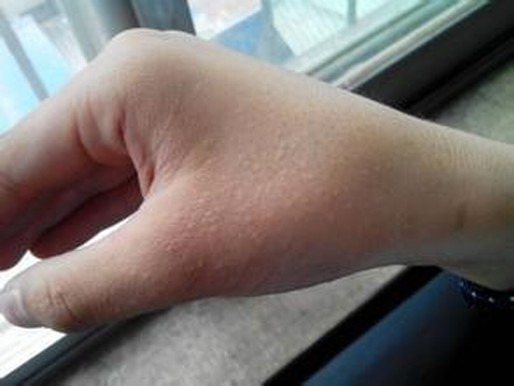 严寒季节怎样的预防冻疮呢