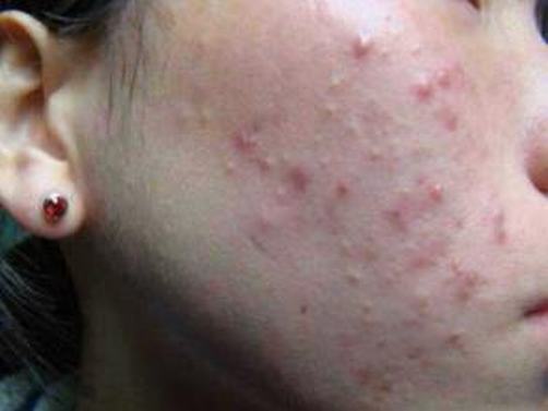 油性粉刺皮肤预防
