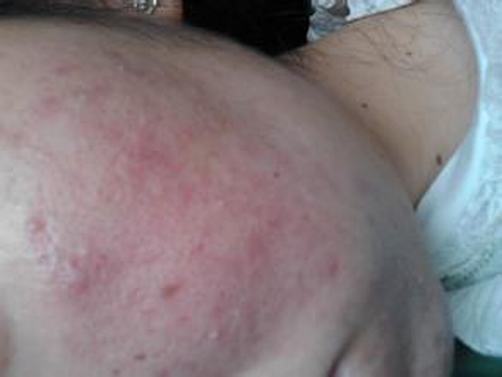 治疗粉刺我们注意什么