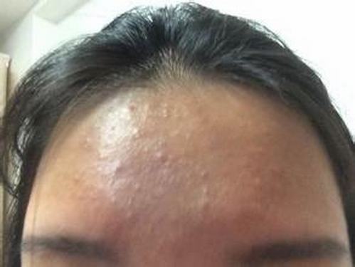 黑头粉刺的调理方法