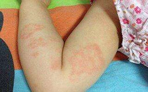风疹的发病特点是什么