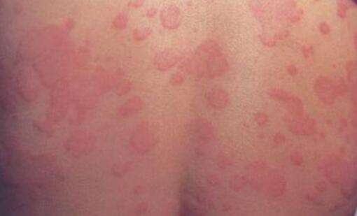 儿童发生风疹的具体危害有什么
