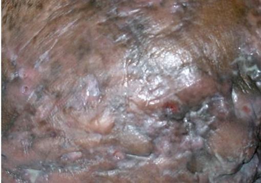 化脓性汗腺炎的预防方法