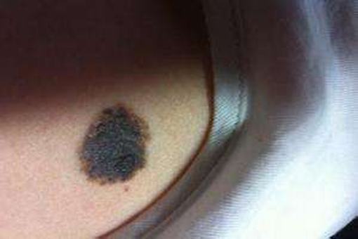 恶性黑色素瘤的肢端雀斑样痣型表现特征