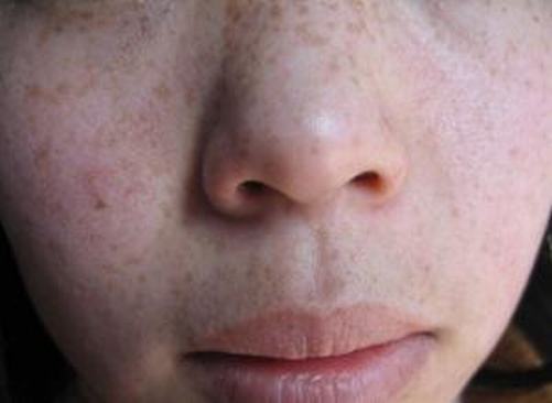 女性黄褐斑有哪些形成的因素