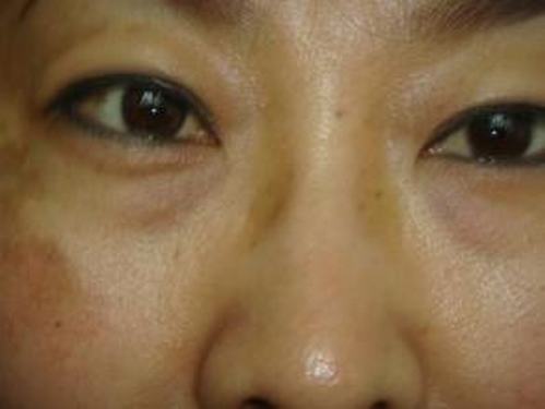 黄褐斑日常要如何护理