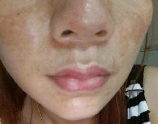 黄褐斑的防止的方式有些什么