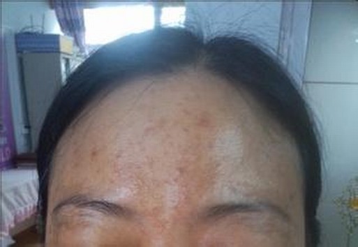 女性桑拿容易得黄褐斑吗