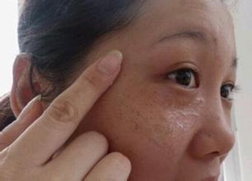 什么因素致使的黄褐斑出现