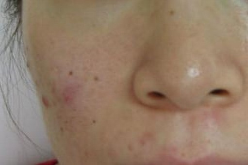 女性如何针对性的抵制黄褐斑