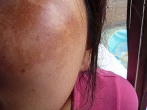 女性黄褐斑诱发的原因