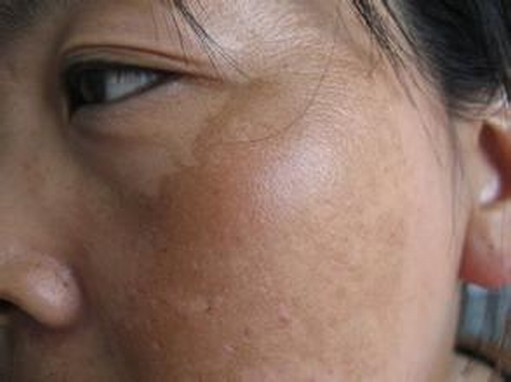 更年期女性该如何怎样的预防黄褐斑
