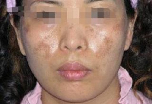夏季女性的黄褐斑会变得愈加严重吗