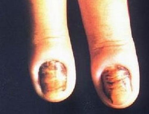 指甲油也会引起甲沟炎