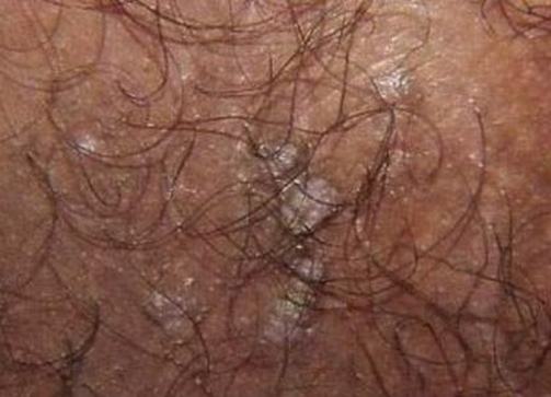 女性尖锐湿疣会发生哪些危害