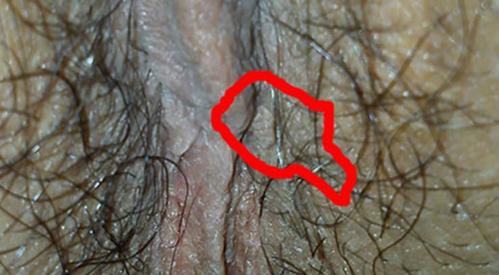 尖锐湿疣通过唾液传染的可能性
