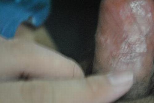 尖锐湿疣是怎样传播的