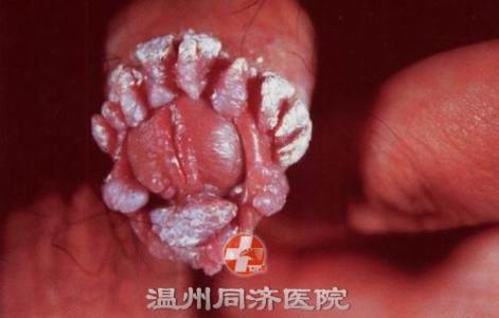 尖锐湿疣不治疗的危害有哪些