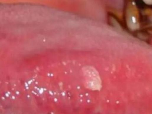 男性尖锐湿疣的饮食注意有哪些