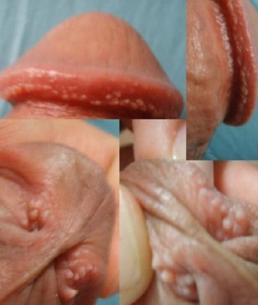 肛门尖锐湿疣有哪些症状