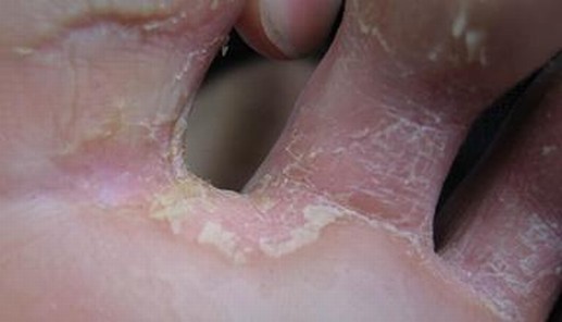 脚气患者宜穿棉袜避免脚部潮湿