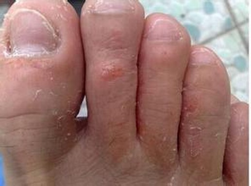 脚气患者要上心一些事项有哪些