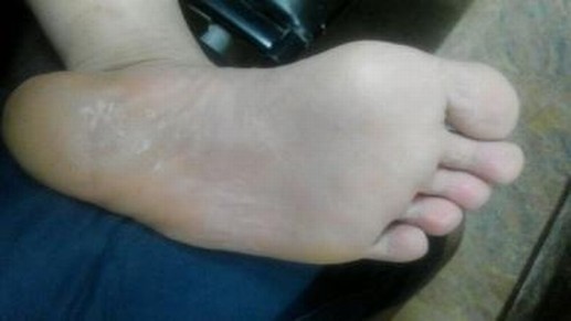 脚气的症状表现有哪些