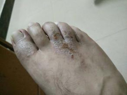 脚气的护理办法有什么呢
