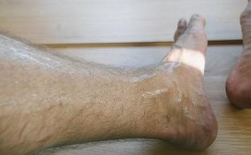 脚气的预防该怎么进行